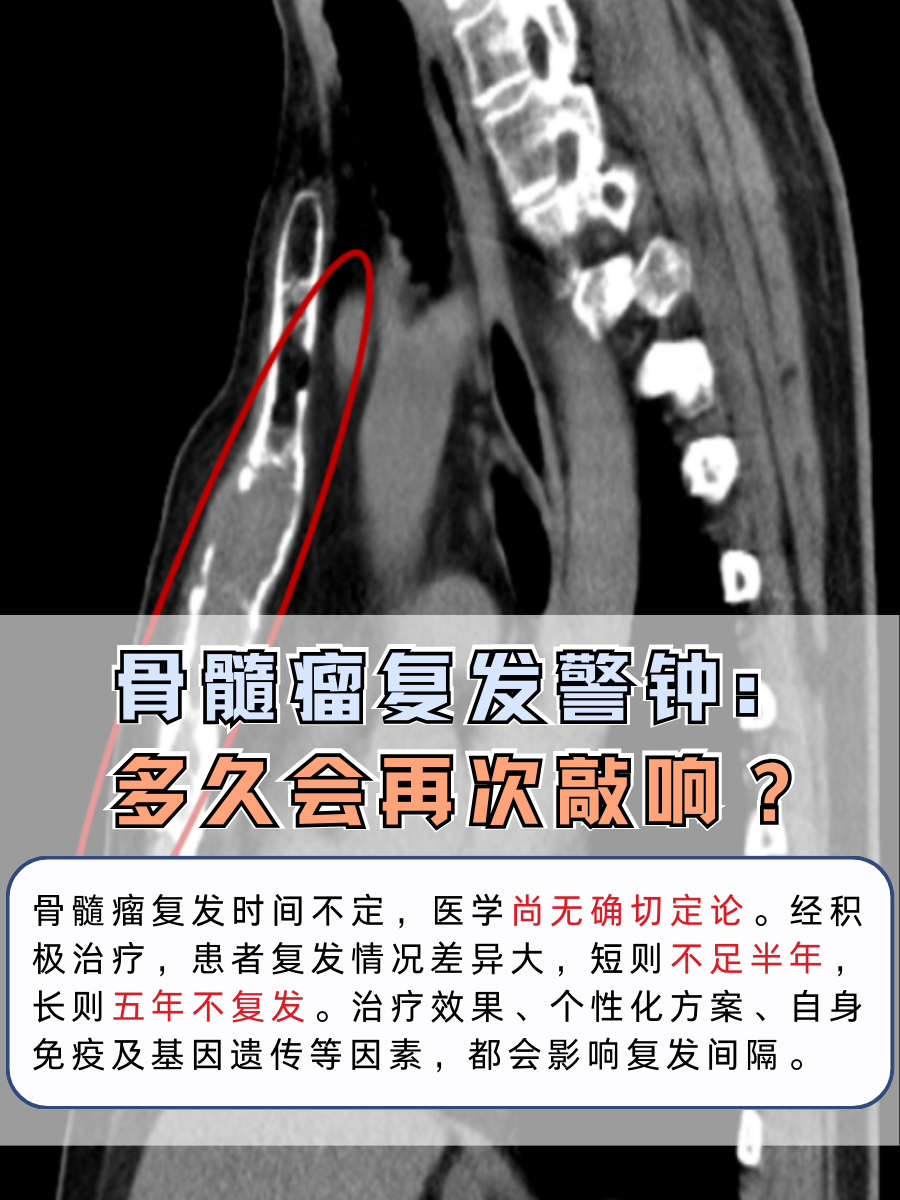 骨髓瘤复发警钟:多久会再次敲响?