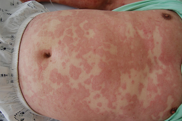 躯干部红色斑疹与斑片图