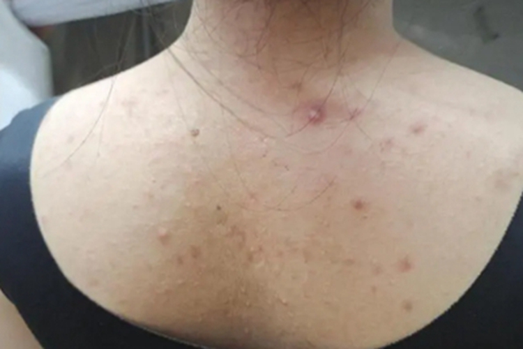 热带痤疮背上长脓包图 热带痤疮背上长脓包图