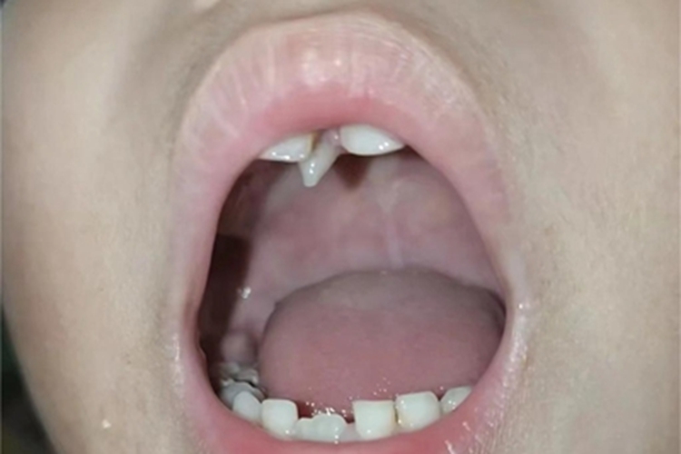 多生牙牙齿症状图