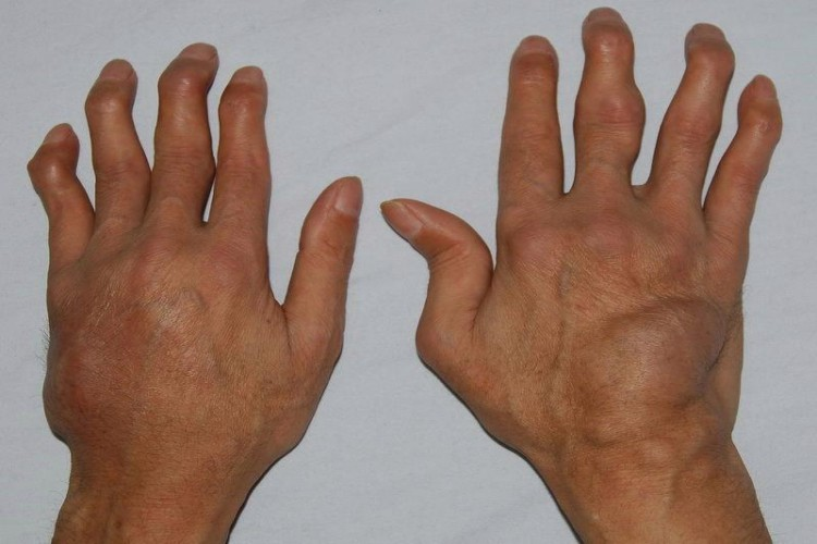 类风湿天鹅颈手指图