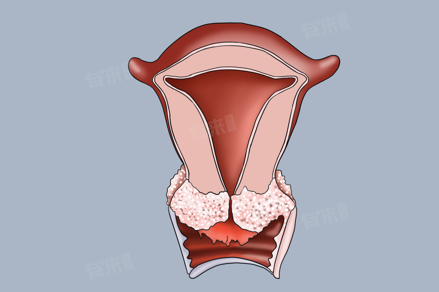 宫颈hpv16型阳性严重吗