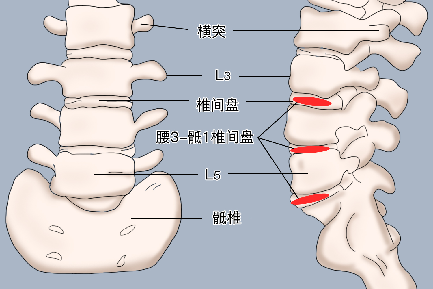 腰3骶1椎间盘位置图 腰3骶1椎间盘位置图