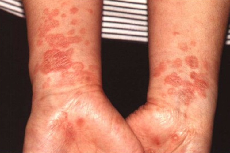 女性结节性梅毒疹图