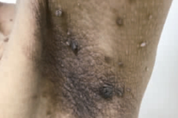 恶性黑棘皮病腋窝症状图