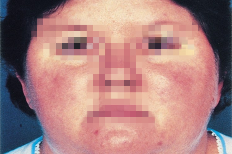 库欣综合征面部水肿图