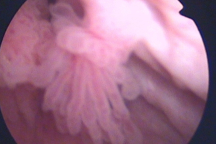 膀胱乳头状瘤乳头状图 膀胱乳头状瘤乳头状图