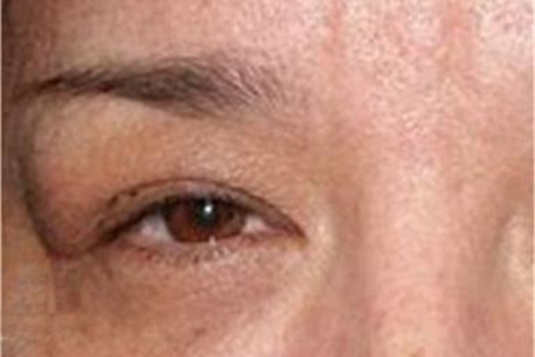 泪腺脱垂眼睑肿块图