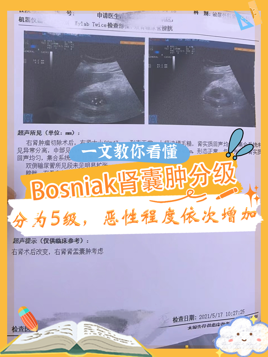 一文教你看懂Bosniak肾囊肿分级