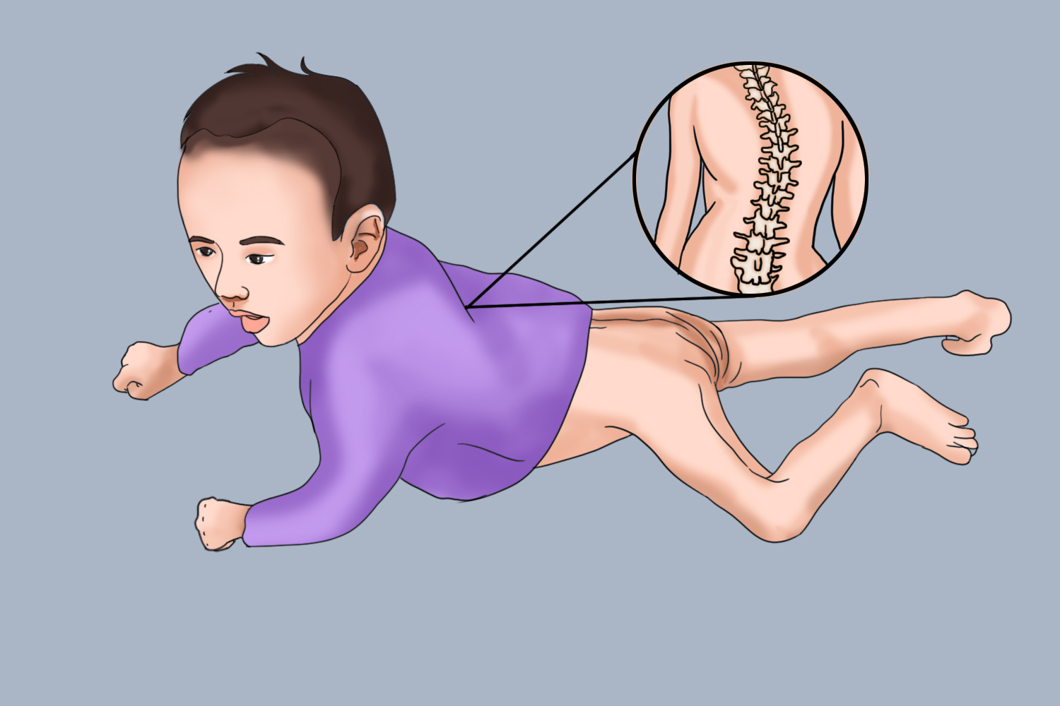 婴儿Ⅱ型脊髓性肌肉萎缩症图