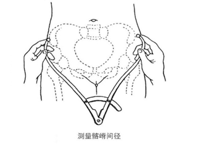 髂脊间径测量图