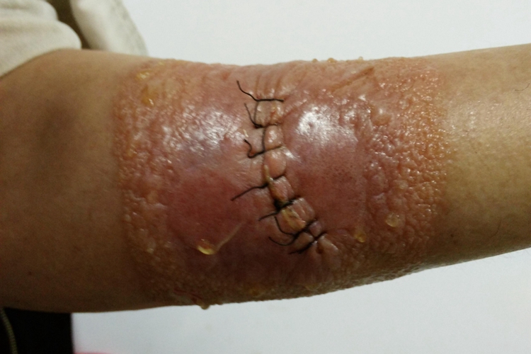 手臂外侧接触性皮炎图