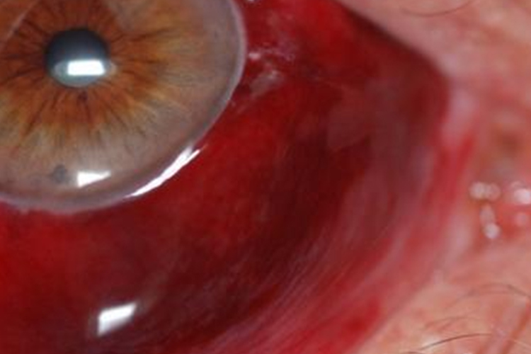 急性出血性结膜炎眼睛流血图