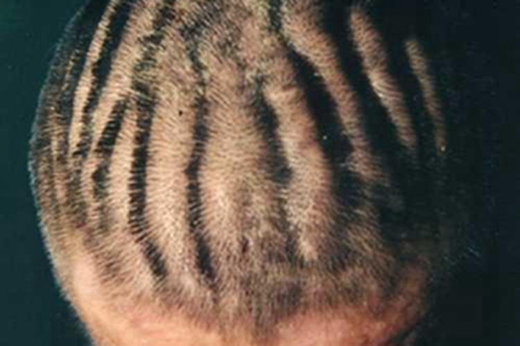 原发性骨膜增生厚皮症头皮有褶图