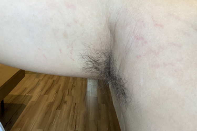 萎缩纹胳膊内侧有红色条纹图