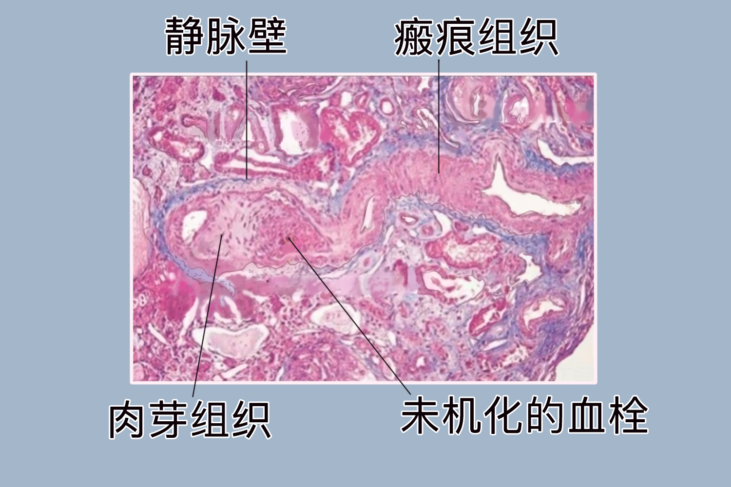 血栓机化手绘图
