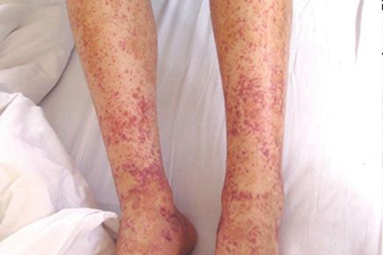 过敏性紫癜小腿有紫色斑点图