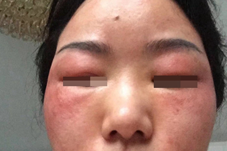 旋毛虫病症状图