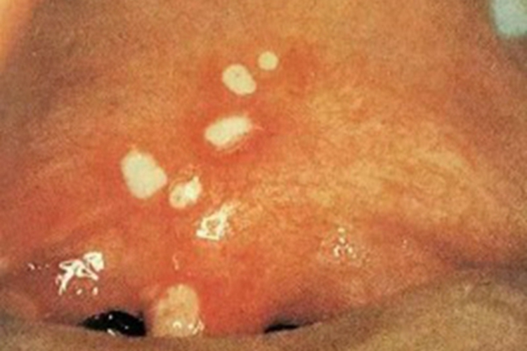 疱疹性咽峡炎白斑图 疱疹性咽峡炎白斑图