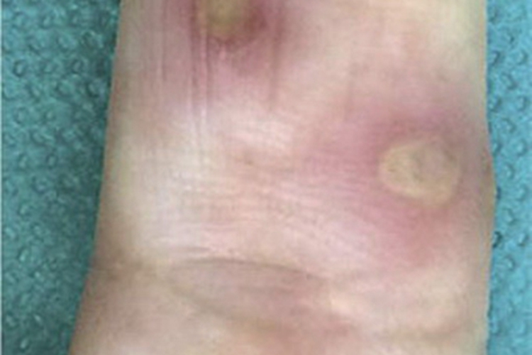 小螺菌型鼠咬热溃疡图