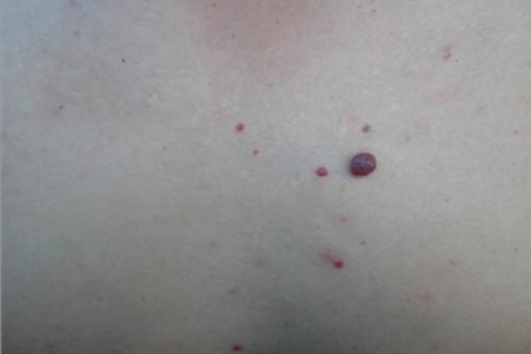 樱桃状血管瘤胸部肉球图 樱桃状血管瘤胸部肉球图