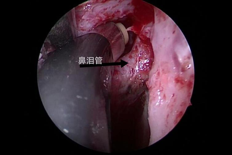 鼻腔血管瘤图 鼻腔血管瘤图