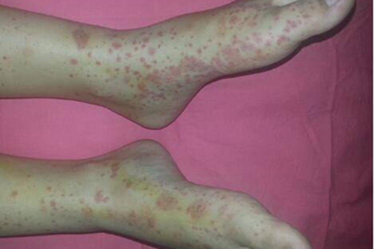 机械性紫癜脚部症状图