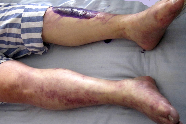 下肢动脉硬化闭塞症图