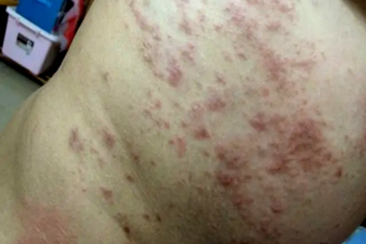 急性湿疹腰部症状图 急性湿疹腰部症状图