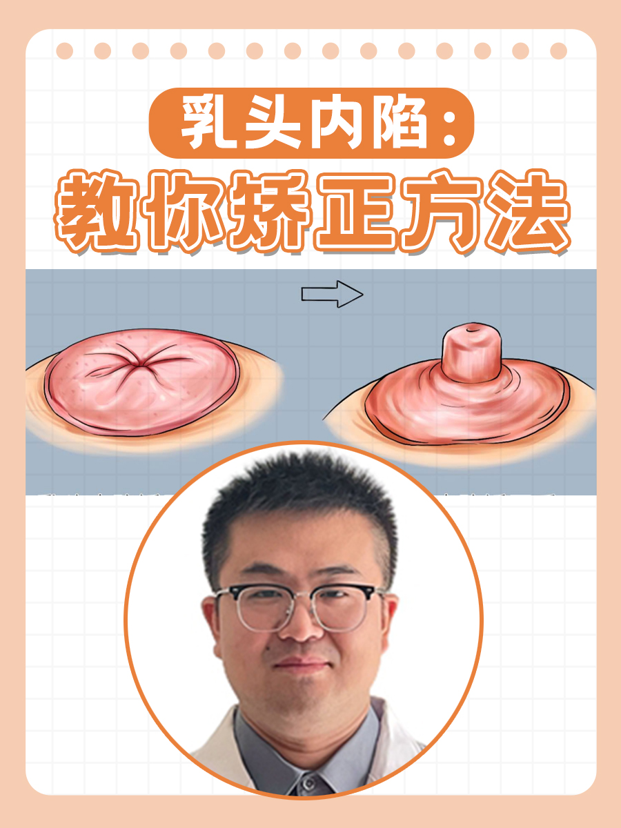 乳头内陷：教你矫正方法