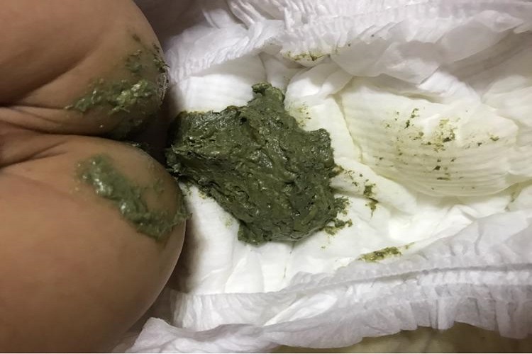 消化不良黑绿色大便图