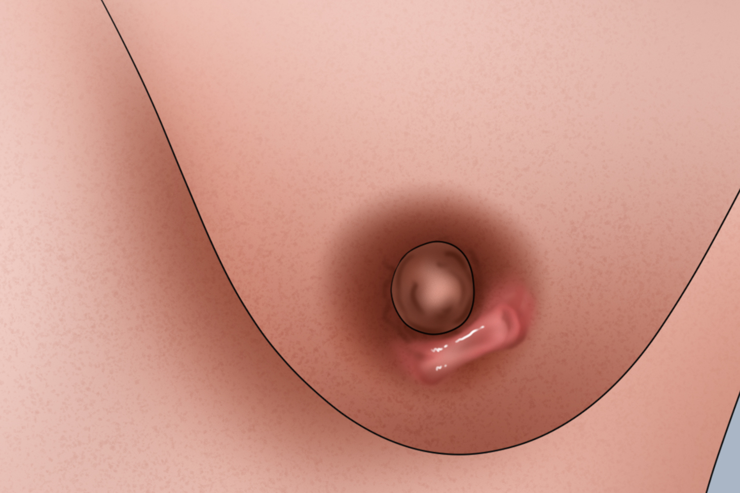 瘢痕疙瘩乳房手绘图