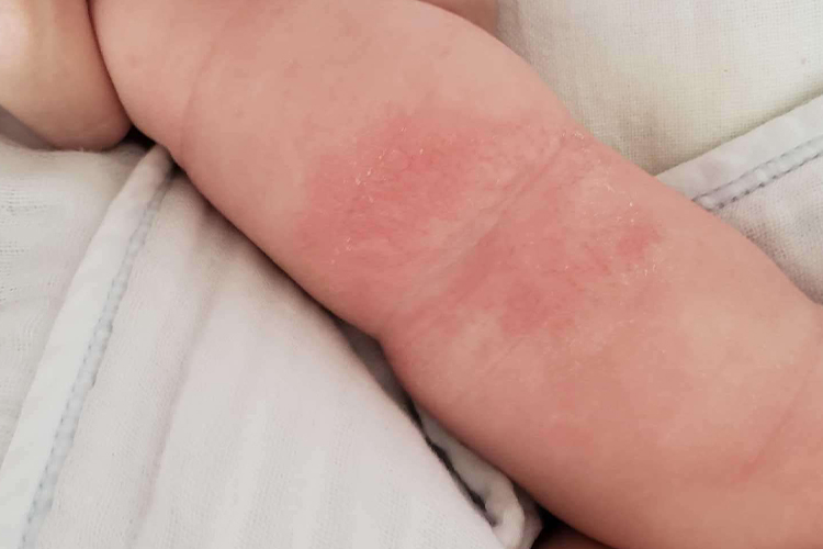 宝宝腿上湿疹图