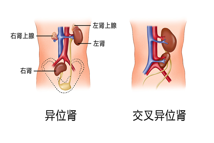 异位肾图