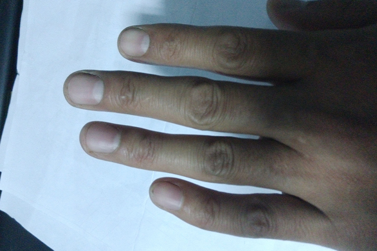 狭窄性腱鞘炎致小指内弯图 狭窄性腱鞘炎致小指内弯图