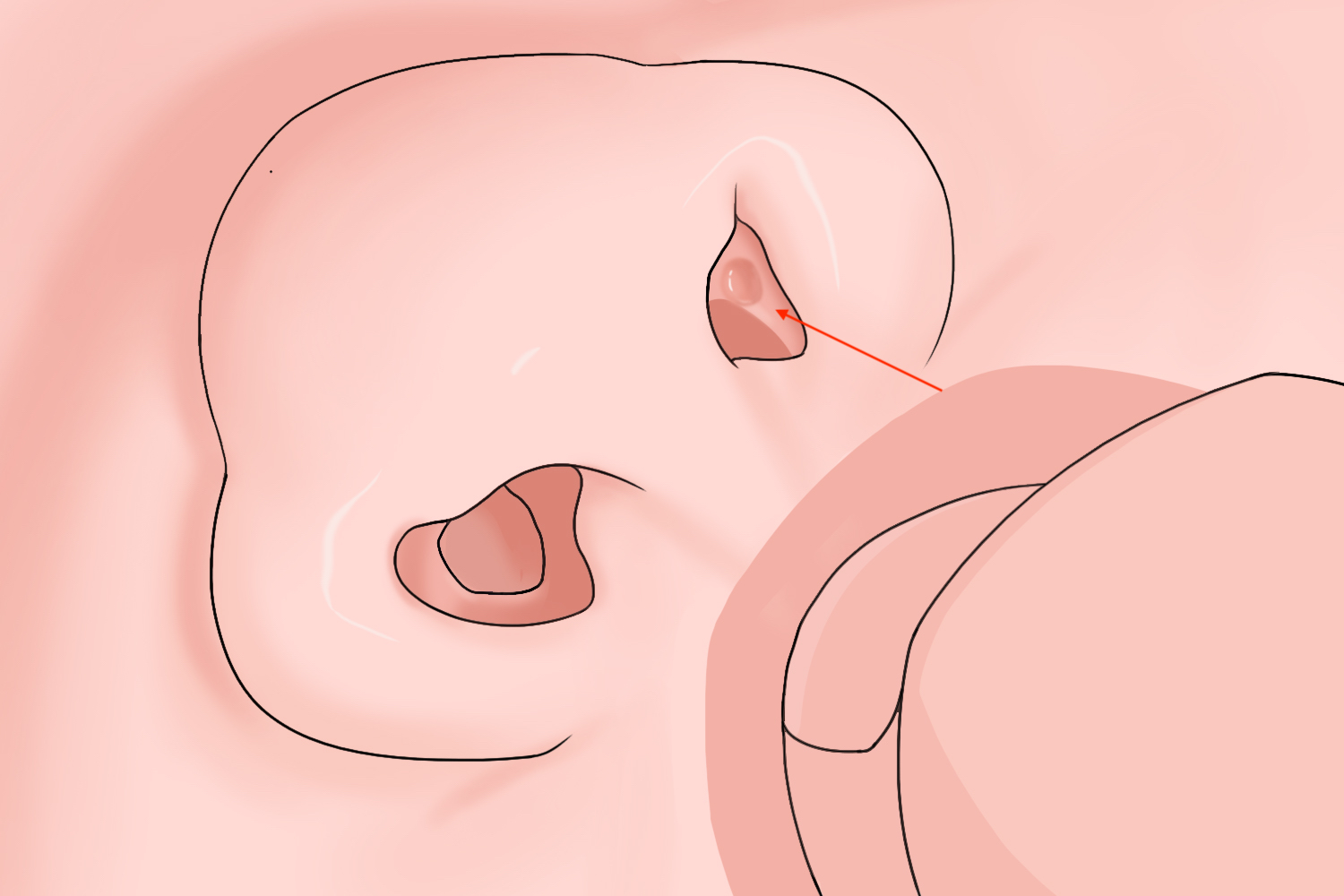 新生儿鼻息肉图