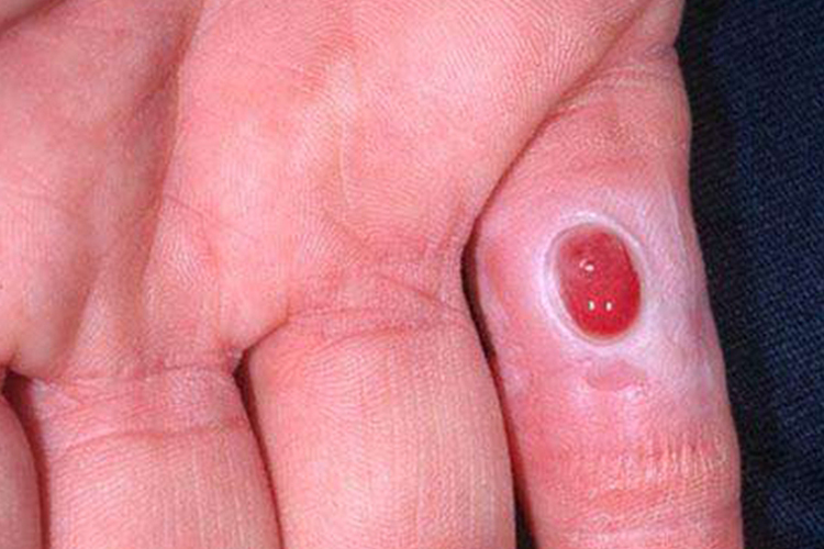 出血性肉芽肿图