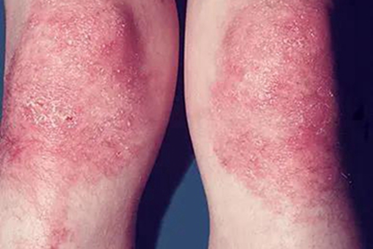 皮肌炎膝盖症状图