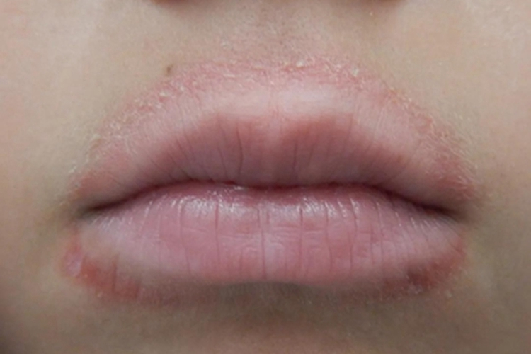 口周皮炎口周红斑脱屑图