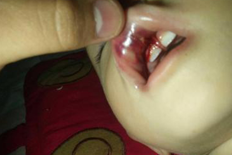 上唇系带断裂严重图