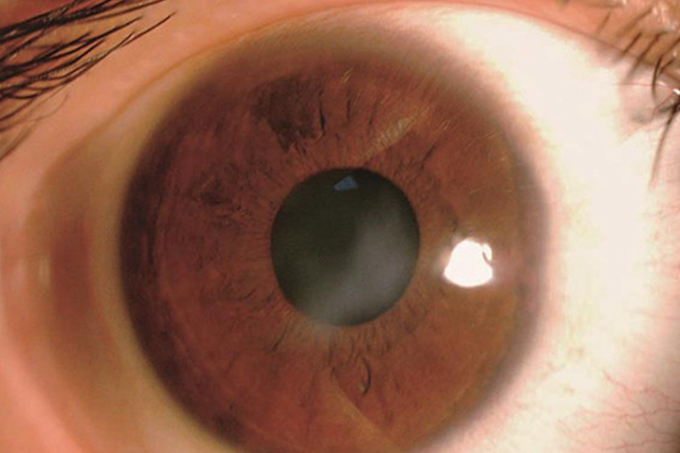 角膜云翳图 角膜云翳图