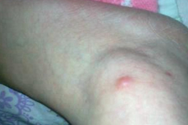 皮脂腺囊肿早期症状图