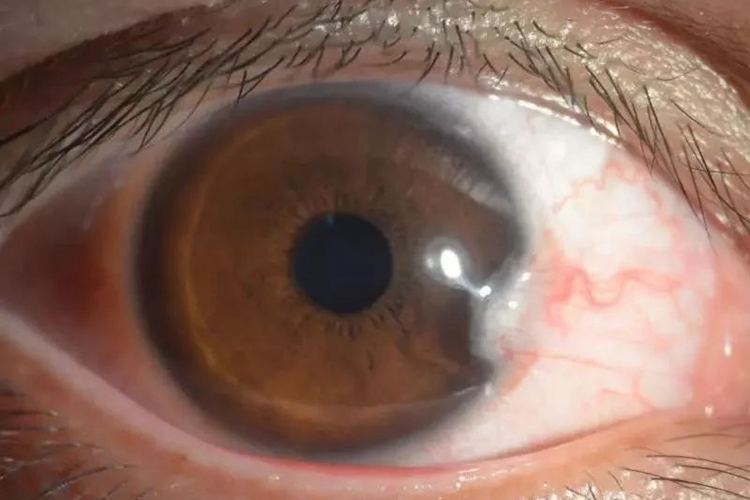 眼睛胬肉早期图