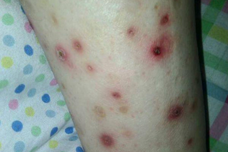 组织胞浆菌病结痂图