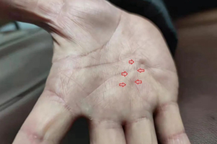 掌腱膜挛缩症症状图 掌腱膜挛缩症症状图
