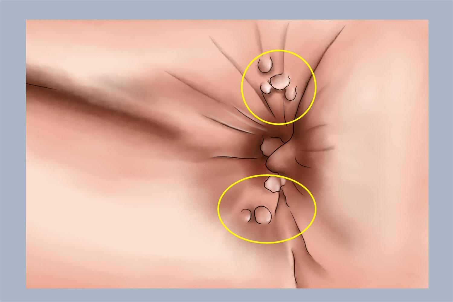 肛门尖锐湿疣肉粒手绘图