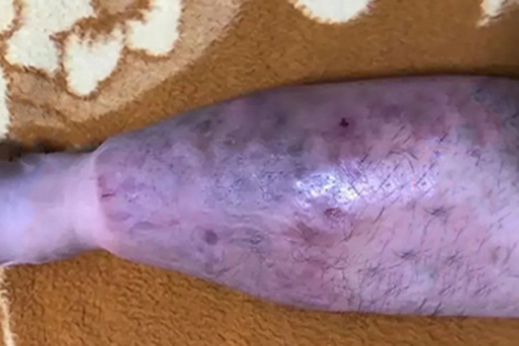 胫前黏液性水肿小腿红肿图