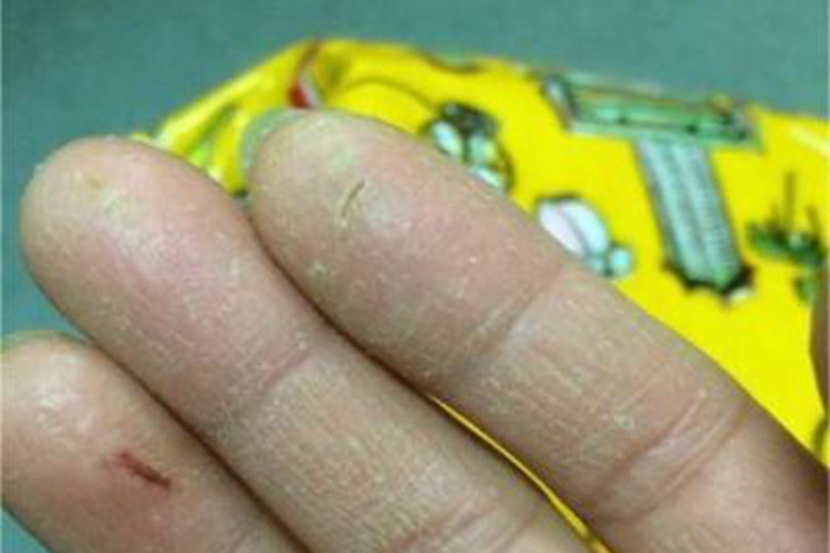 手足皲裂手指症状图