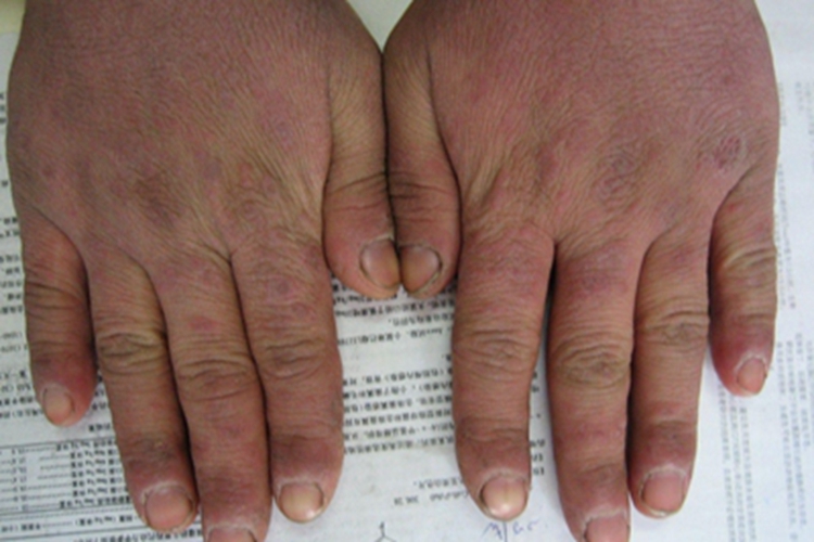 盘状红斑狼疮手背有暗红斑块图 盘状红斑狼疮手背有暗红斑块图