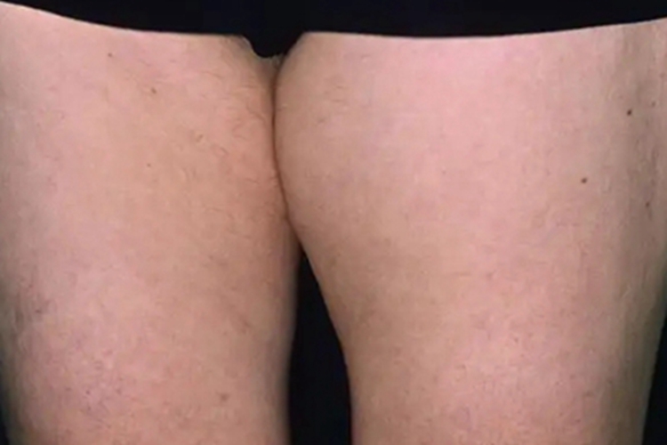 成人型纤维肉瘤大腿症状图